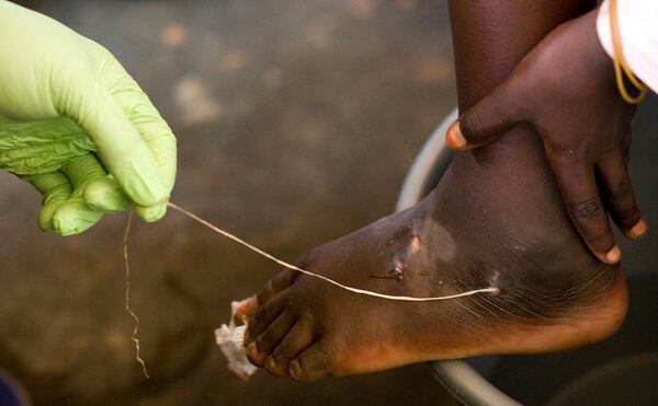 FILE - In this March 9, 2007 file photo, a guinea worm is extracted by a health worker from a child's foot at a containment center in Savelugu, Ghana. (AP Photo/Olivier Asselin, File)